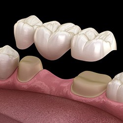 Illustration of traditional dental bridge being placed on prepared teeth