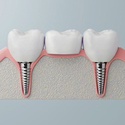 Digital image of dental implant bridge