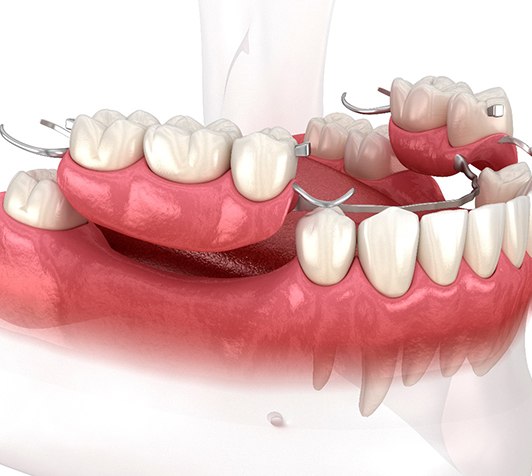 Image of a partial dentures with metal framework 